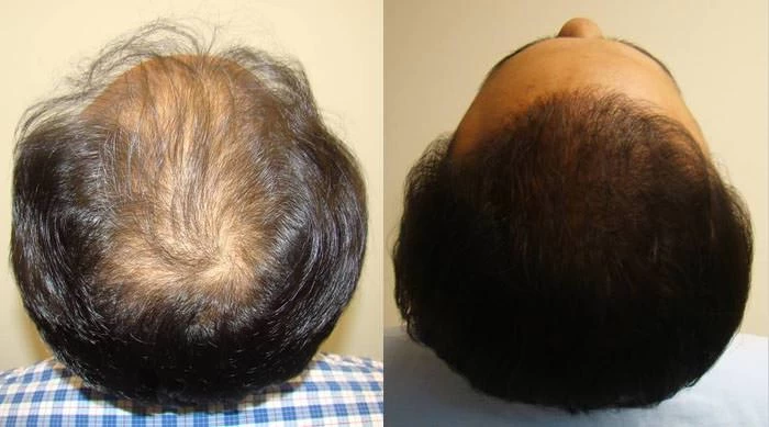 Patient p63 hair transplant before and after crown view