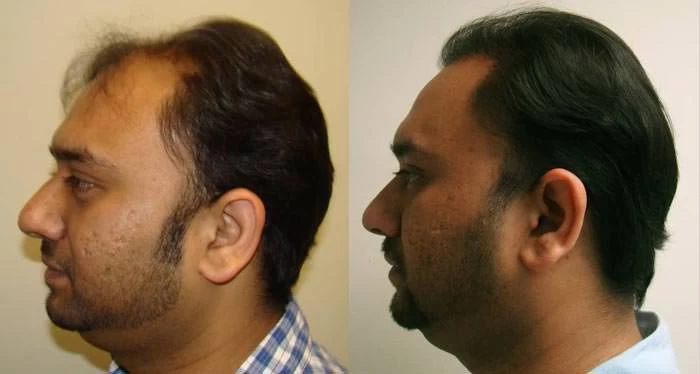 Patient p63 hair transplant before and after left view