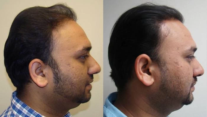 Patient p63 hair transplant before and after right view