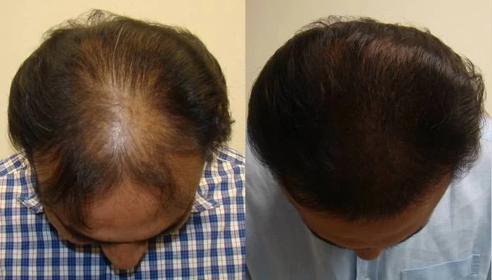 Syed Hair Transplant Before and After