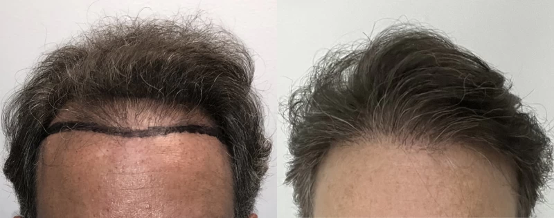 Patient 640 Hair Transplant Before and After