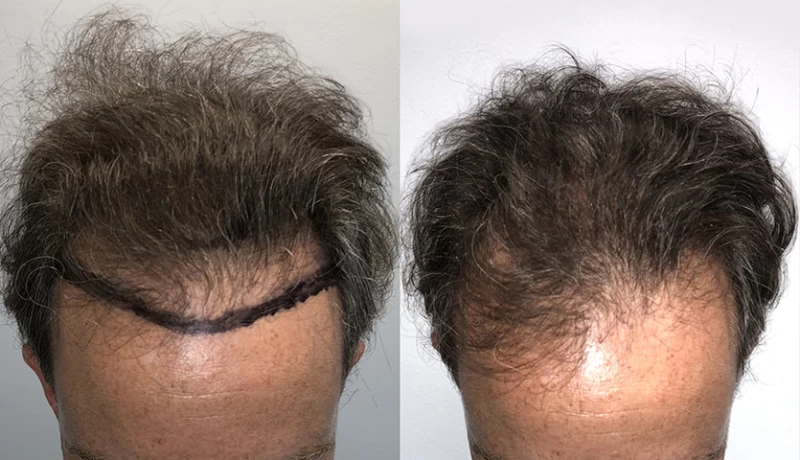 Patient p640 hair transplant before and after tilt view
