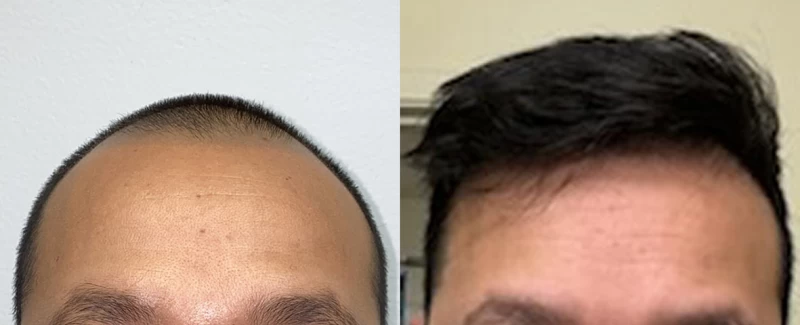 Patient 641 Hair Transplant Before and After