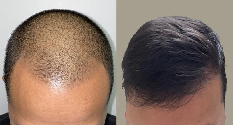 Patient p641 hair transplant before and after tilt view