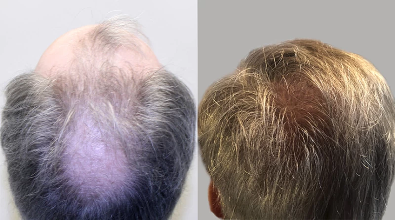 Patient p644 hair transplant before and after crown view