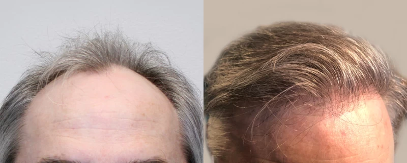 Patient 644 Hair Transplant Before and After