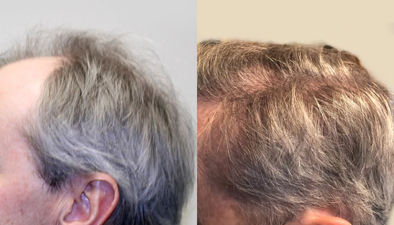 Patient p644 hair transplant before and after left view