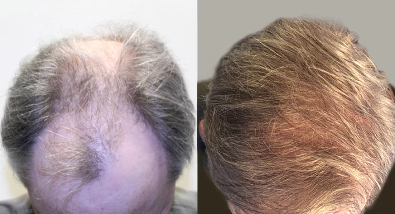 Patient p644 hair transplant before and after tilt view