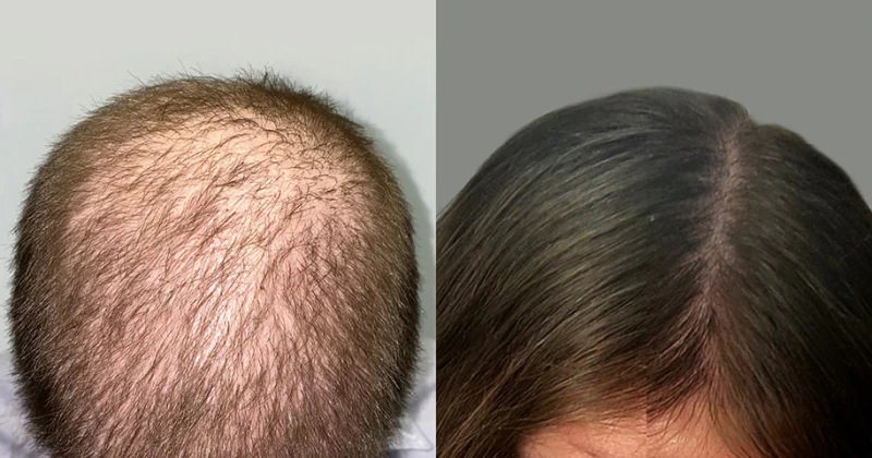 Patient 645 Hair Transplant Before and After