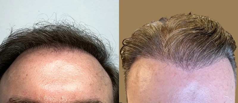 Patient 646 Hair Transplant Before and After
