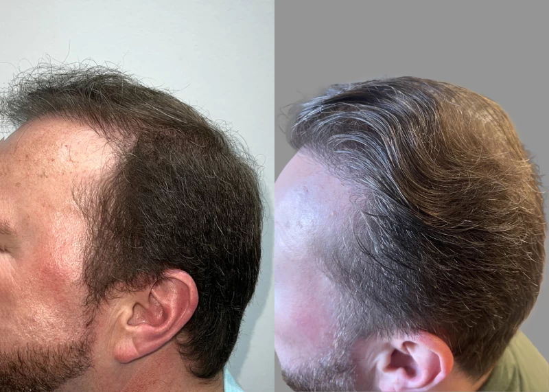Patient p646 hair transplant before and after left view
