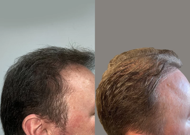Patient p646 hair transplant before and after right view