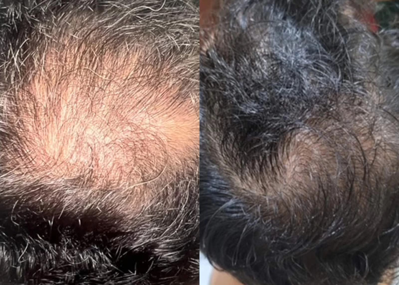 Patient 647 Hair Transplant Before and After