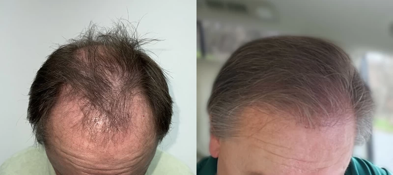 Patient 649 Hair Transplant Before and After
