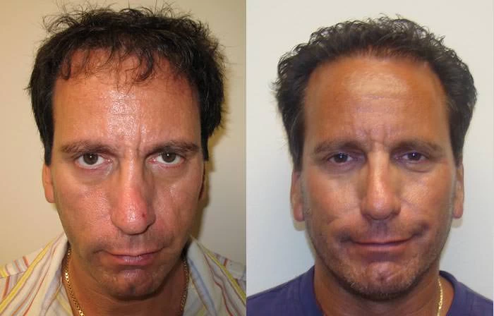 David Hair Transplant Before and After