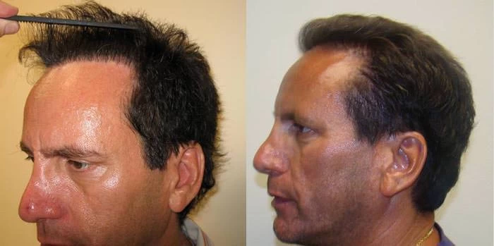 Patient p64 hair transplant before and after left view
