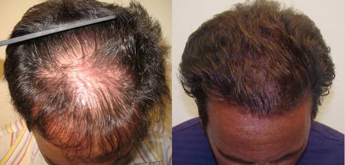 Patient p64 hair transplant before and after tilt view