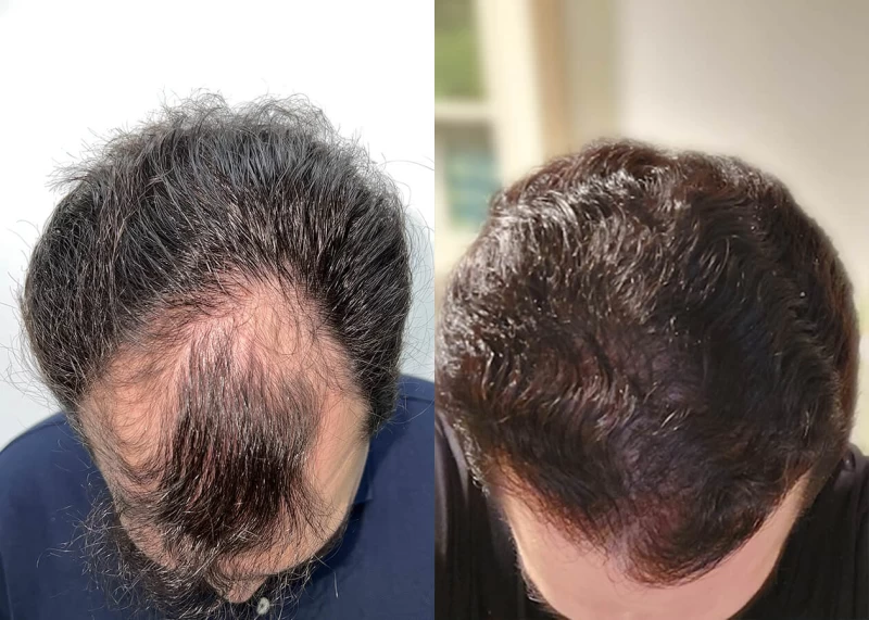 Patient 650 Hair Transplant Before and After