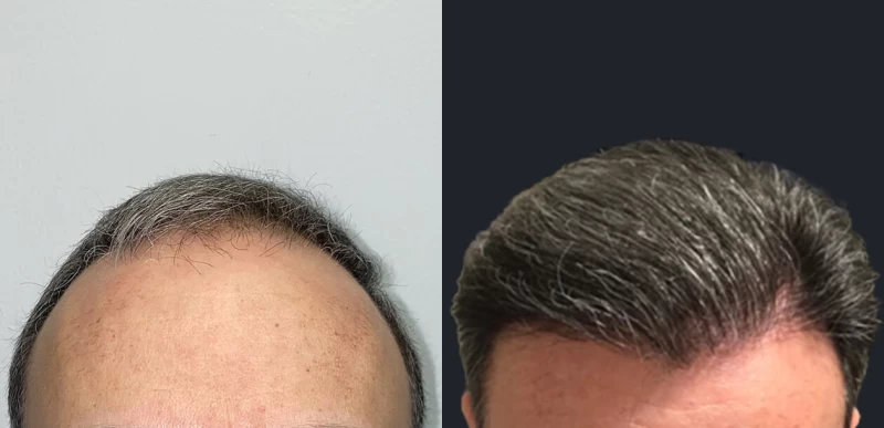 Patient 651 Hair Transplant Before and After