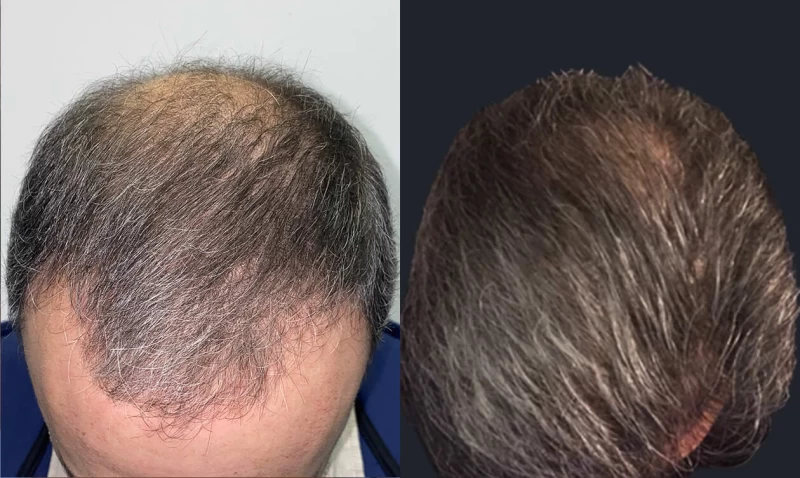 Patient p651 hair transplant before and after tilt view