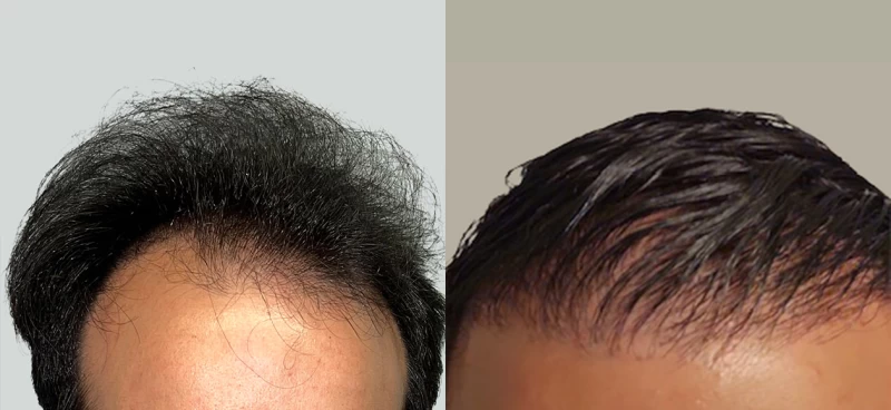 Patient 653 Hair Transplant Before and After