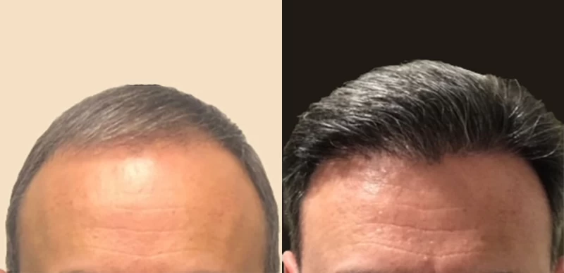 Patient 654 Hair Transplant Before and After
