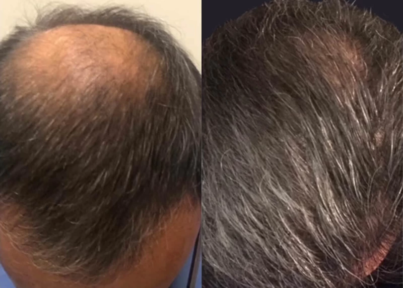 Patient p654 hair transplant before and after tilt view