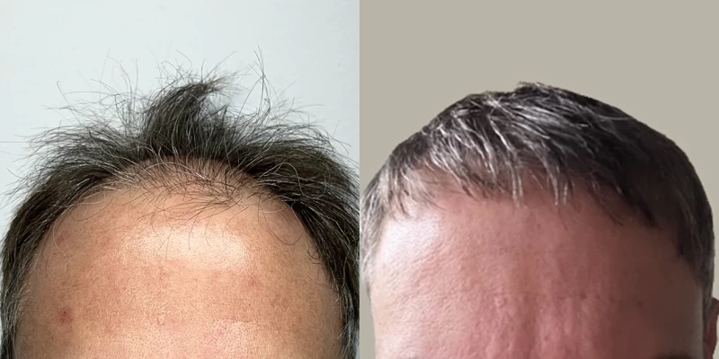 Patient 655 Hair Transplant Before and After