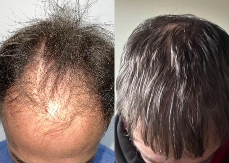 Patient p655 hair transplant before and after tilt view