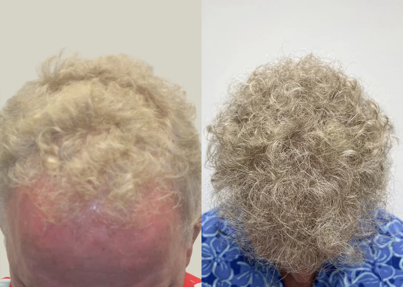 Patient 656 Hair Transplant Before and After
