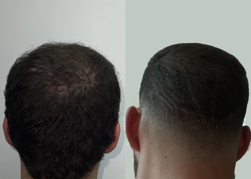 Patient p657 hair transplant before and after crown view