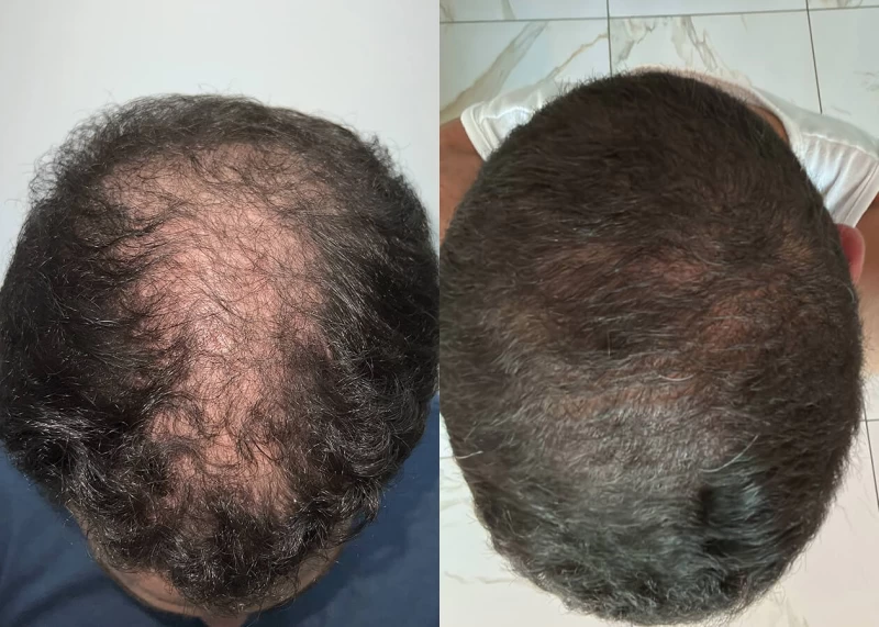 Patient 657 Hair Transplant Before and After
