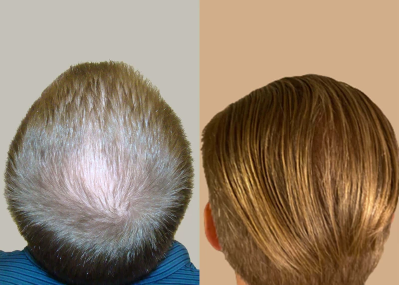 Patient p658 hair transplant before and after crown view