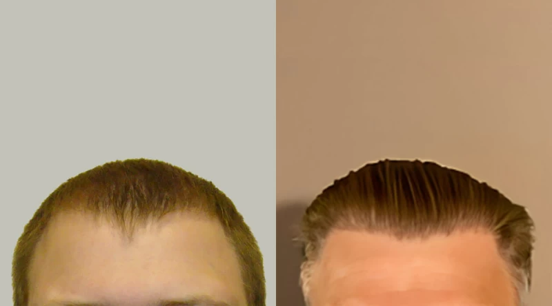 Patient 658 Hair Transplant Before and After