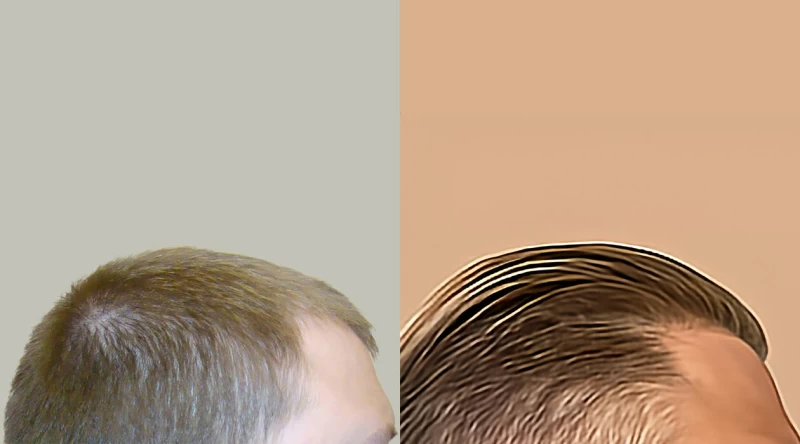 Patient p658 hair transplant before and after right view
