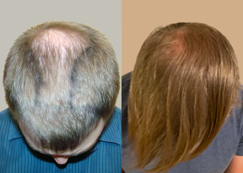 Patient p658 hair transplant before and after tilt view