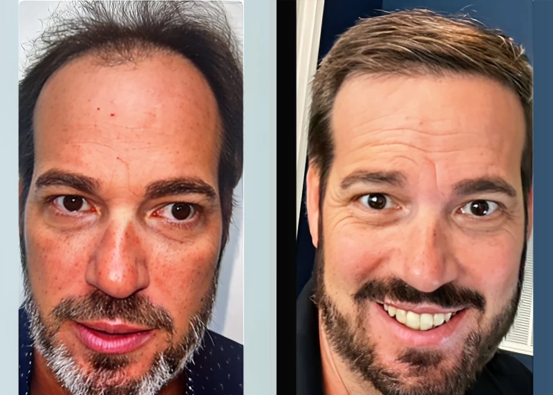Patient 659 Hair Transplant Before and After