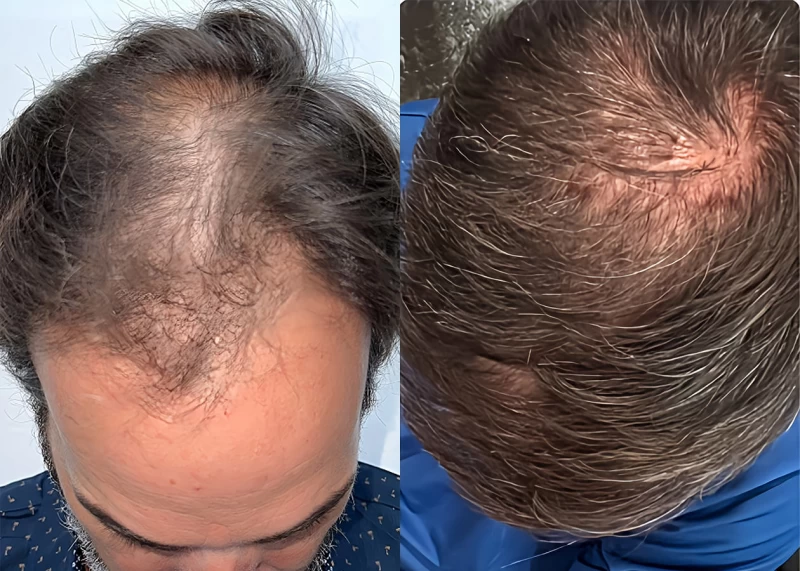 Patient p659 hair transplant before and after tilt view