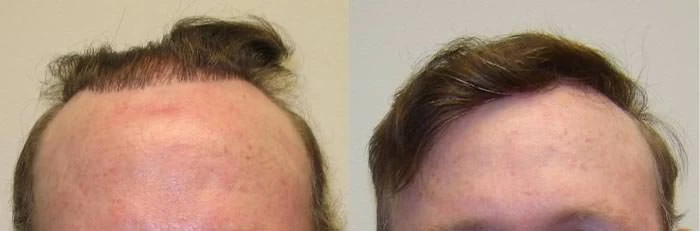 Patient 65 Hair Transplant Before and After