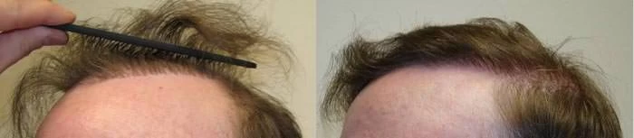 Patient p65 hair transplant before and after left view