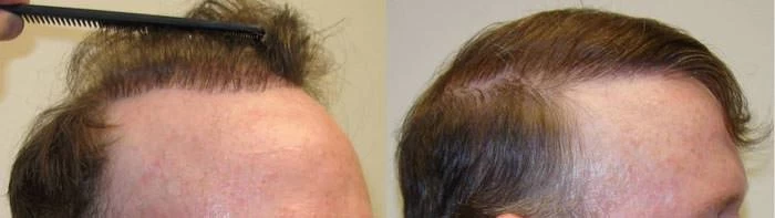 Patient p65 hair transplant before and after right view