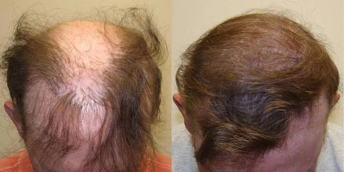 Patient p65 hair transplant before and after tilt view