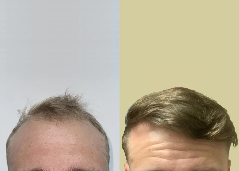 Patient 660 Hair Transplant Before and After