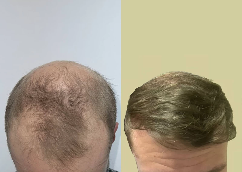 Patient p660 hair transplant before and after tilt view