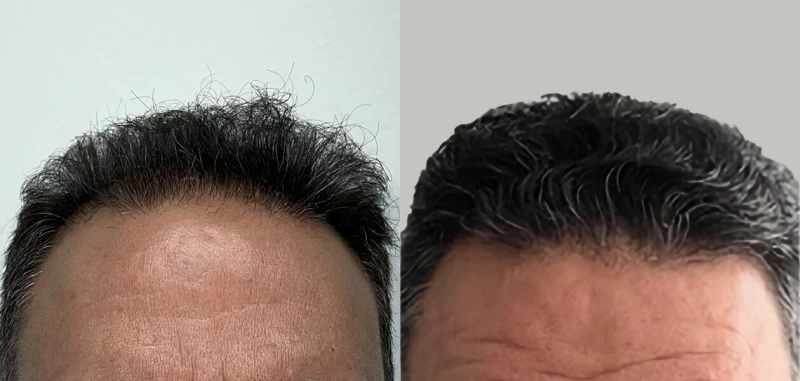 Patient 662 Hair Transplant Before and After