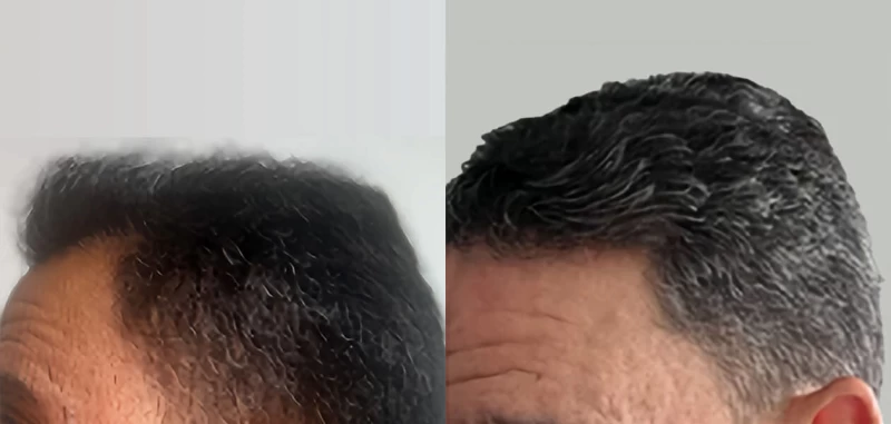 Patient p662 hair transplant before and after left view