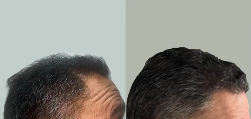 Patient p662 hair transplant before and after right view