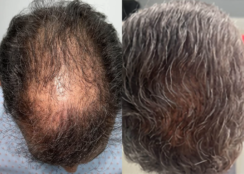 Patient p662 hair transplant before and after tilt view