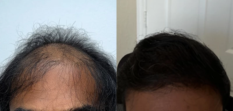 Patient 663 Hair Transplant Before and After