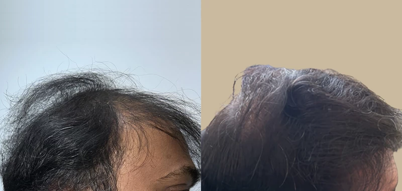 Patient p663 hair transplant before and after right view